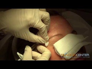 Filler for Forehead Wrinkles procedure
