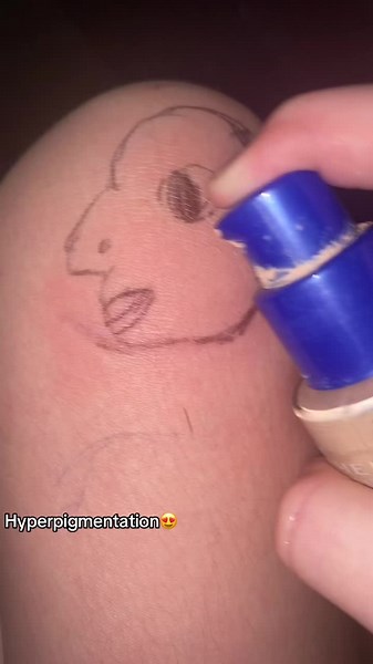 Understanding Hyperpigmentation: Causes, Treatments, and More!