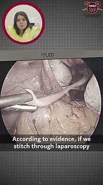 How We Save Pregnancies After 2nd Trimester Losses: Cervical Cerclage via Laparoscopy
