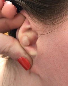 Pimple Popping Videos on Instagram: "Explosion!!!  ⁣ ➖➖➖➖➖➖⁣⁣⁣⁣⁣⁣⁣⁣⁣⁣⁣⁣⁣⁣⁣⁣⁣⁣⁣⁣⁣⁣⁣ FreePimplePopper.com⁣⁣⁣⁣⁣⁣⁣⁣⁣⁣⁣⁣⁣⁣⁣⁣⁣⁣⁣⁣⁣⁣⁣ ➖➖➖➖➖➖⁣⁣⁣⁣⁣⁣⁣⁣⁣⁣⁣⁣⁣⁣⁣⁣⁣⁣⁣⁣⁣⁣⁣ #Pimples #pimpleproblems #blackheads #whiteheads #cyst #pimplepoppervids"