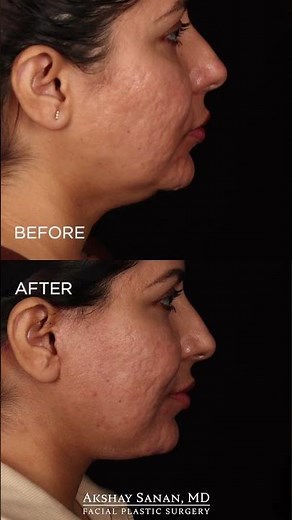Deep plane facelift and deep neck lift incisions explained by Dr. Sanan
