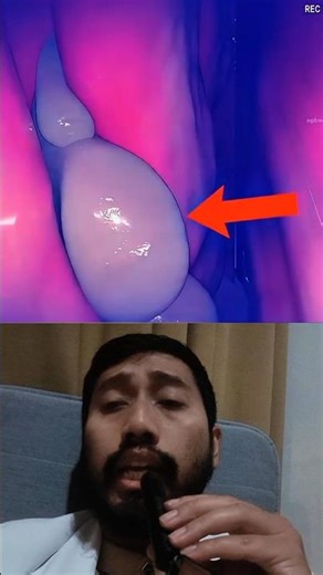 Nasal Polyps 🤔 What are they and why do they appear? #healthfacts #uniquefacts #drbimo