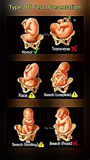 Types Of Fetal Presentation #medical #baby