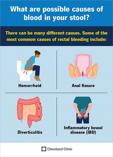 What Does Blood in Your Poop Mean?