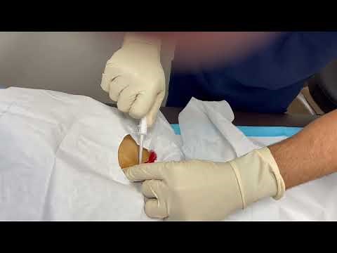 Testopel Testosterone Therapy - Testosterone Pellet Insertion Procedure