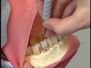 Calculus Removal Stroke