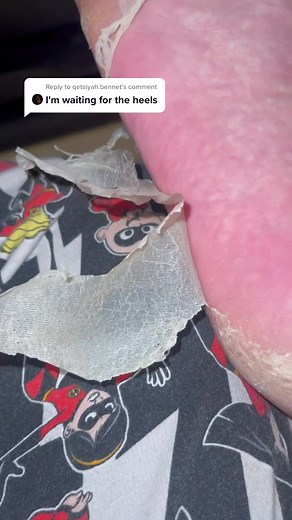 Reply to @qetsiyah.bennet Heels are crunchy #Foot #footpeel #asmr #satisfying #relaxing