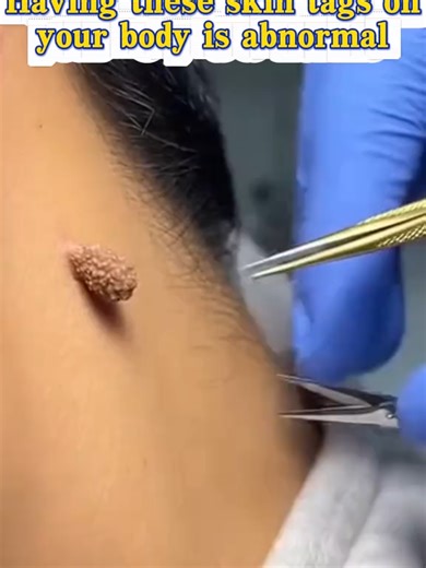 This wart remover can help you with most skin.