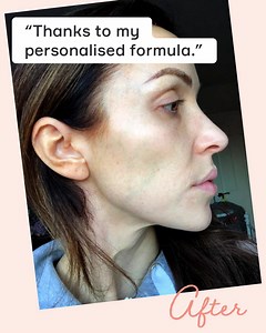 267 reactions · 27 shares | Get a personalised formula to treat dark spots, pigmentation, fine lines, sun damage and more! | Dermatica | Facebook