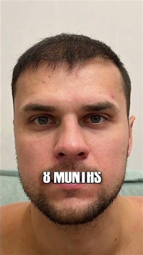 From Bald to Full Head of Hair in One Year #hairtransplant #results #transformation