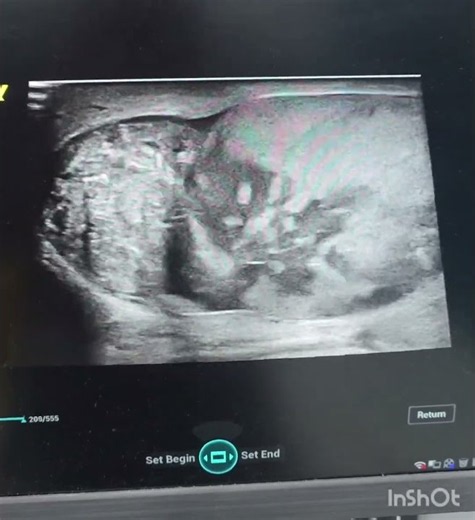Testicular Torsion on Ultrasound | Absent Testicular Blood Flow & Twisted Spermatic Cord