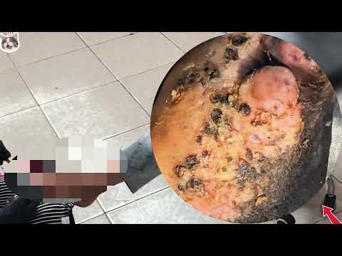 Extreme Jigger Infestation – Unexpected Deep Tissue Impact! #ED365