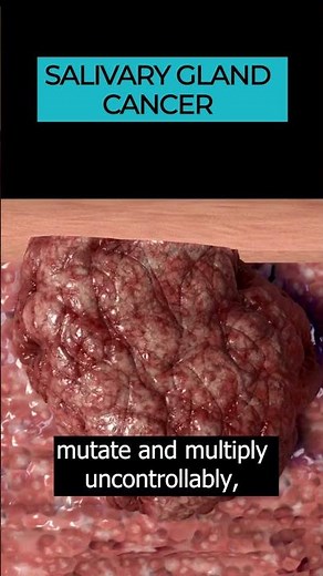 Salivary Gland Cancer: Uncovering Head and Neck Cancer Types 🎗️🩺