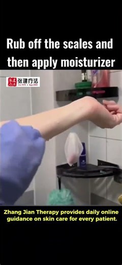 Rub off the scales and then apply moisturizer #ichthyosistreatment#ichthyosis#ichthyosisvulgaris