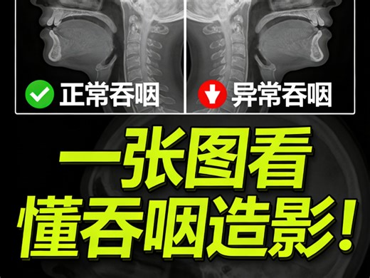 康复人必看！正常吞咽和异常吞咽的造影对比