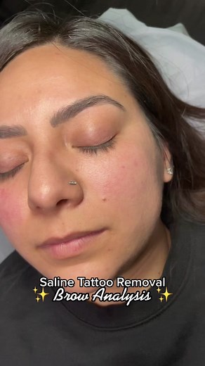 We will be lightening enough to do a coverup/correction. We’ll see you in 6-8 weeks with results from her removal session ✨ #microblading #microbladingbrows #microbladinggonebad #microbladingprank #tattooremoval #browremoval #salinetattooremoval #salineremoval