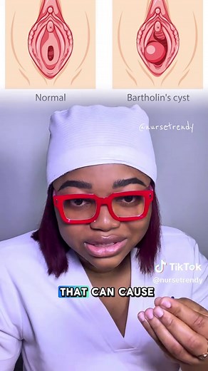 Understanding Bartholin’s Gland Cysts and Their Treatment