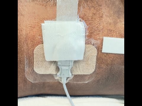 How To Clean A Diaphragmatic Pacer Site