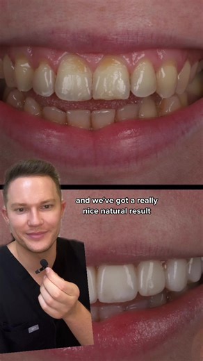 Transform Your Smile with Veneers and Composite Bonding