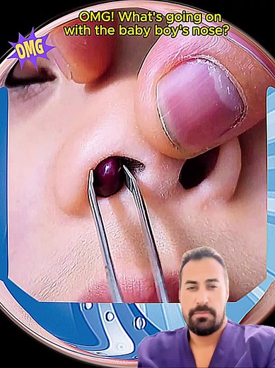 Effective Earwax Removal Techniques for Healthy Ears