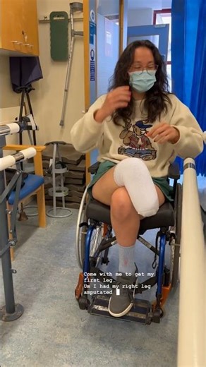 Her First Step After Amputation | Below Knee Prosthetic Leg Fitting #preventamputations