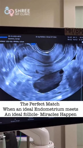 Jay Mehta on Instagram: "When the Best Endometrium meets the Best Follicle. The patient experiences a potential of natural conception to the tune of 10-12% in every month. It is important that the couples understand that they are supposed to have routine intercourse every day or every alternate during the fertile window in order to achieve a natural conception. Follow For More! #RecurrentPregnancyLoss #PregnancyLoss #SeptateUterus #HysteroscopicSurgery #UterineAnomaly #InfertilitySolutions #Fert