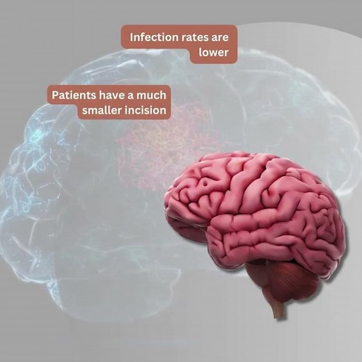 Benefits of Keyhole Brain Surgery Over Open Brain Surgery | Minimally Invasive Neurosurgery
