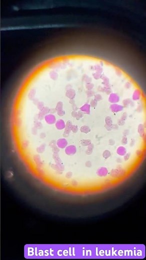 Blast cells in Leukemia | Leukemia diagnosis By Microscopy