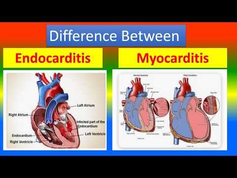 Differences between Endocarditis and Myocarditis