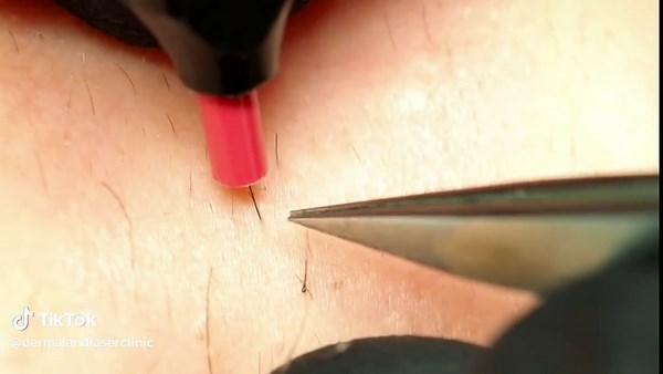 Discover Electrolysis Hair Removal: What to Expect