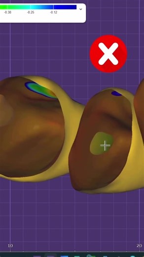 Exocad Tips for Dental Technicians