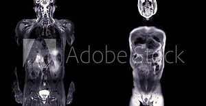 MRI whole body scan Coronal T2 and T1 by MRI scanner.