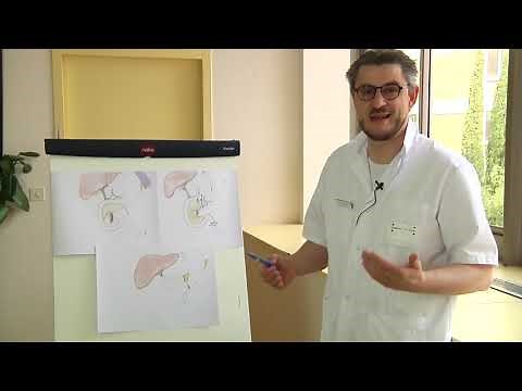 Chirurgie digestive : technique moins invasive pour résection de la tête du pancréas lors de tumeur