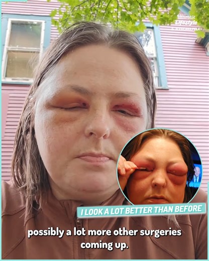 127K views · 548 reactions | My swollen eyes won't stop growing and the emergency room won't help me  | Ultimate | Facebook