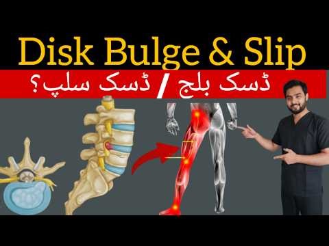 “Disk Bulge: Causes, Symptoms & Effective Treatment Options You Must Know!”