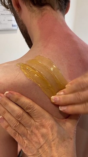 Sugaring some long strong hairs #eyebrowwaxsing #sugaring #hairremoval #beautytherapist #salon #salon #sugarpaste #sugarwax