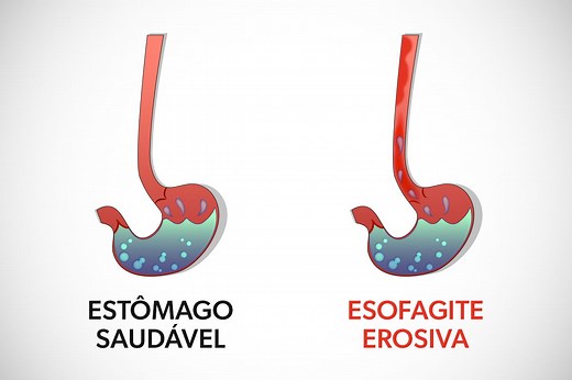 Esofagite erosiva: o que é, sintomas e classificação de Los Angeles