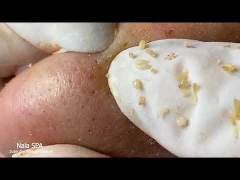 Pimple Popping #21 | Relax every day with Nala SPA