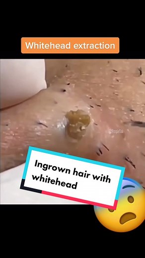 Whotehead extraction. #cystpopping #oddlysatisfying #pimplepopperaddict #dilatedpore #whiteheadpimples #blackheadsremoval #cystexplosion #pimplepopper #extractions
