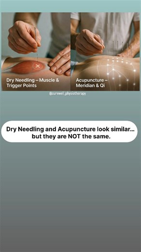 curewell physiotherapy on Instagram: "Dry Needling and Acupuncture may use similar needles, but they are based on different principles and techniques. They look the same, But, they are NOT the same. Dry Needling vs Acupuncture 🪡 Same needle. Different science. 👉 Save this before your next treatment. Understanding the difference helps you choose the right treatment. 👉 follow @curewell_physiotherapy for more physiotherapy advice. #dryneedling #acupuncture #triggerpoint #meridian #qi #painrelief