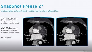 Motion correction on cardiac CT can be challenging, but vendors have developed software solutions to help reconstruct images to filter out motion artifacts, especially at higher heart rates. This video clip shows examples of GE Healthcare's SnapShot Freeze 2 motion correction software. It was highlighted in its virtual booth at the Society of Cardiovascular Computed Tomography (SCCT) virtual meeting this past week. The software is automated to aid in whole heart motion correction. Read about oth