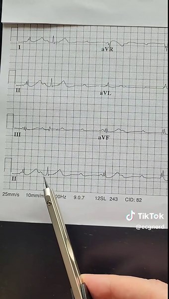 high-grade AV block #ecg #ekg #cardiology #heartblock