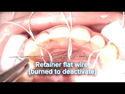 Amazing!! Fixed retainer placed on in few minutes, the easiest approach