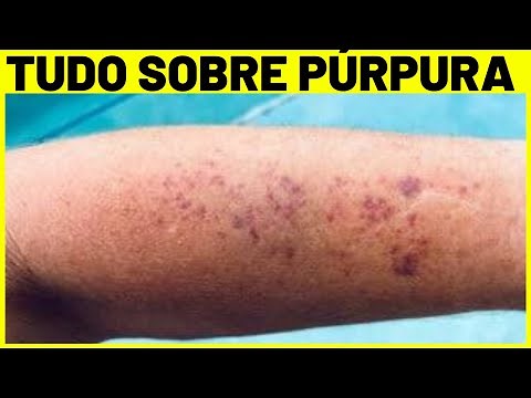 PÚRPURA - O QUE É, CAUSAS, SINTOMAS E TRATAMENTO