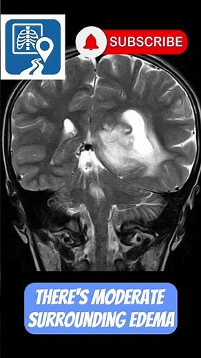 What’s Going On Inside This Brain Lesion? #radiology