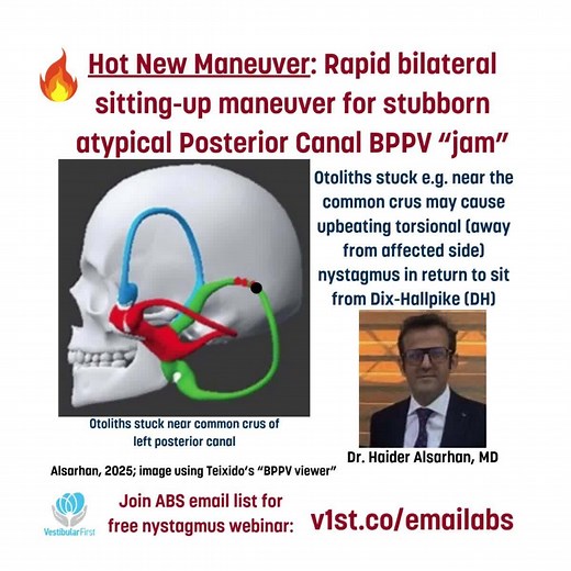 JUST Published: rapid bilateral sitting-up maneuver for atypical posterior canal BPPV by Dr. Haider Alsarhan! Also, catch a free webinar on "Recognizing Eye Movements and Nystagmus" on Tuesday, November 4, 8 PM Eastern. Join the ABS email list at v1st.co/emailabs to get the link! #bppv #vestibular | Vestibular First