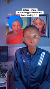 779K views · 6.7K reactions | Before i knew i was having Scleroderma, I was having this symptoms  | Life with Violetemor | Facebook