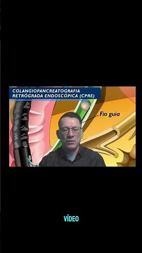 CPRE - Exame de Colangiopancreatografia