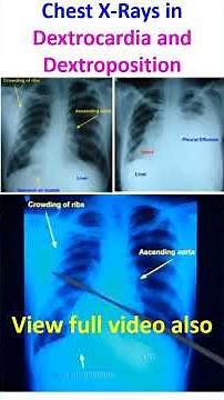 Chest X-Rays in Dextrocardia and Dextroposition