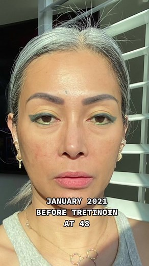 A before and after comparison with tretinoin use. Amazing how my skin has improved a lot! I am so happy I did it and never gave up during the ugly and purging phase. It is all worth it!😊 #50yearsyoung #aginggracefully #agingwell #tretinoin #tretinoinbeforeandafter #tretinoinresults #tretinoincream #fyp #foryou #foryoupage